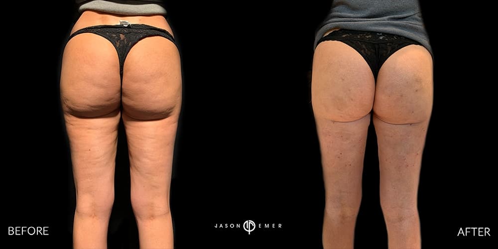Cellulite Reduction