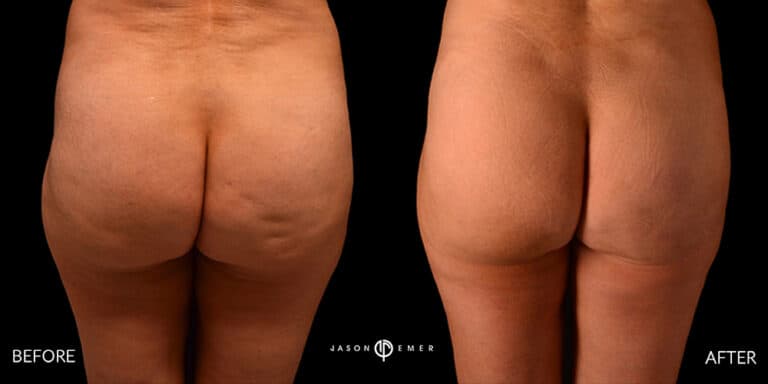 CELLULITE REDUCTION GALLERY 02