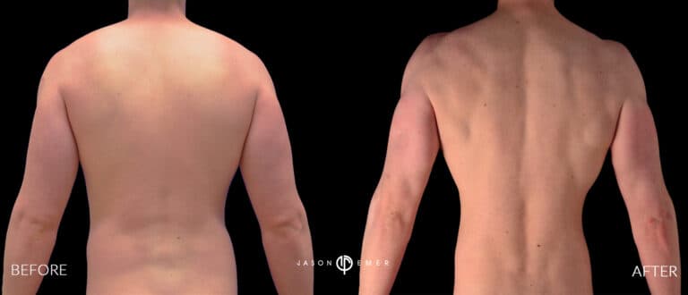 Back Male Gallery 01
