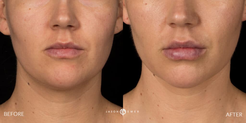 lip filler