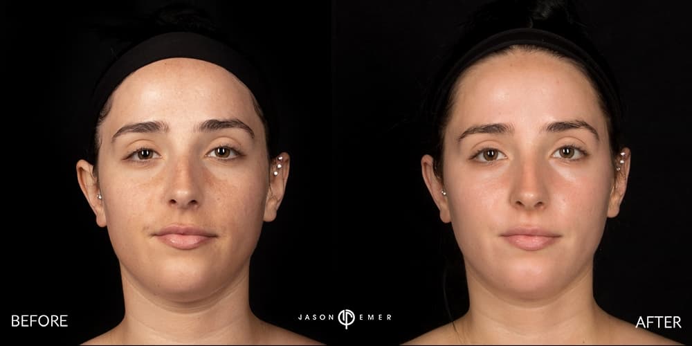 Chemical Peels Gallery