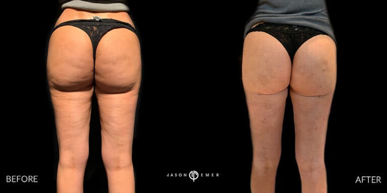 CELLULITE REDUCTION GALLERY 01