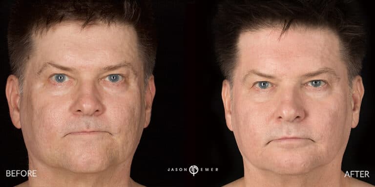 ACNE SCAR TREATMENT GALLERY 01