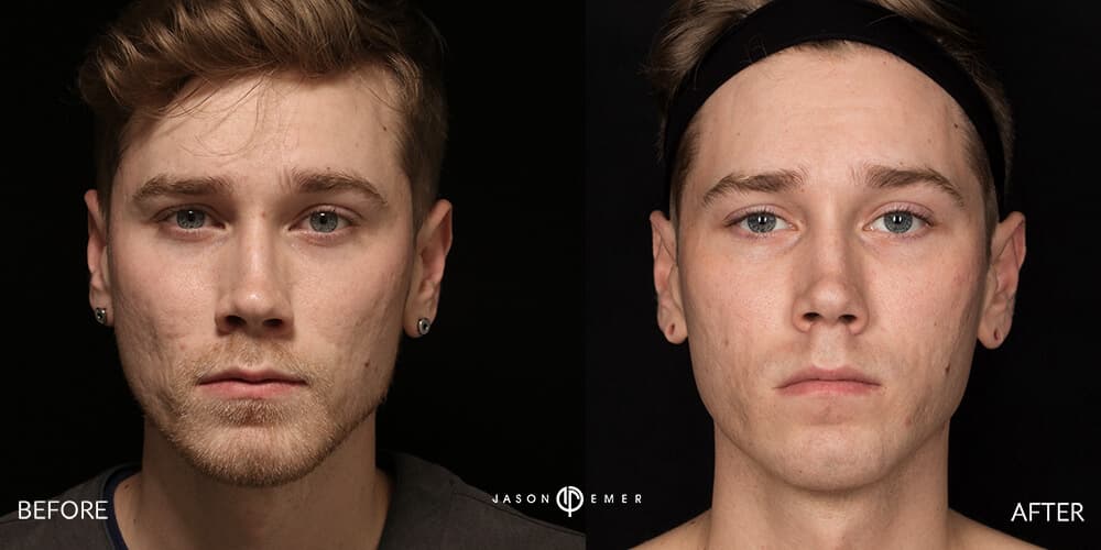 Acne scar best before and after los angeles beverly hills