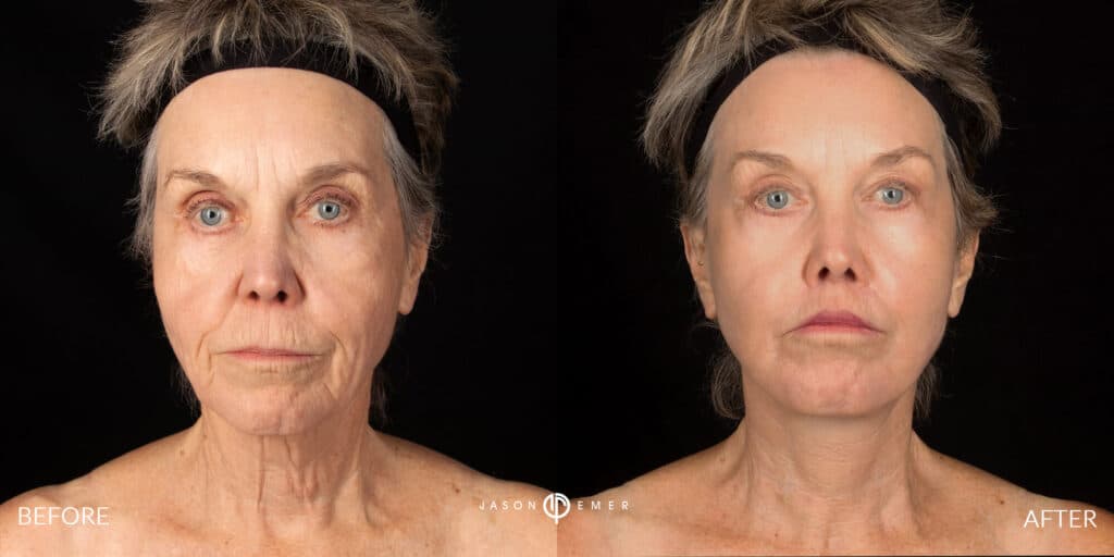 Face lift gallery
