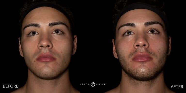 Lip Filler Male Gallery 01
