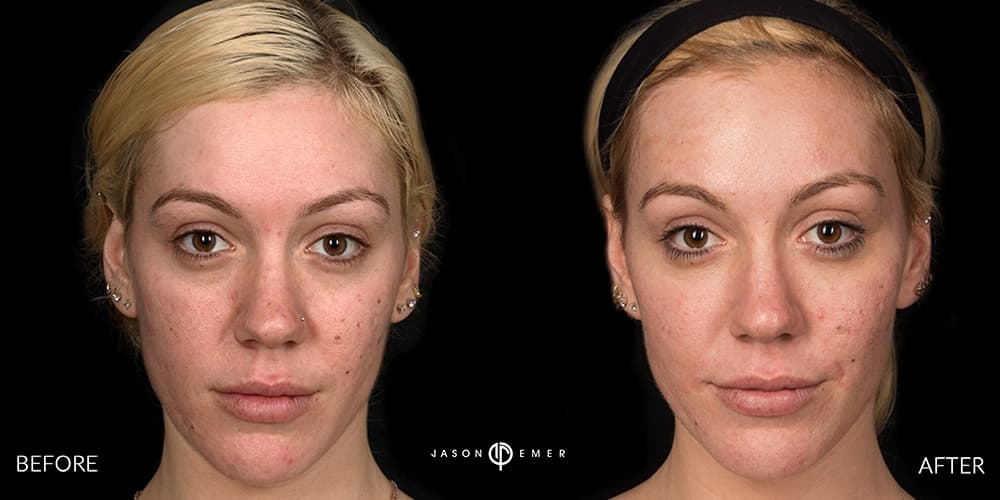 Laser Skin Resurfacing
