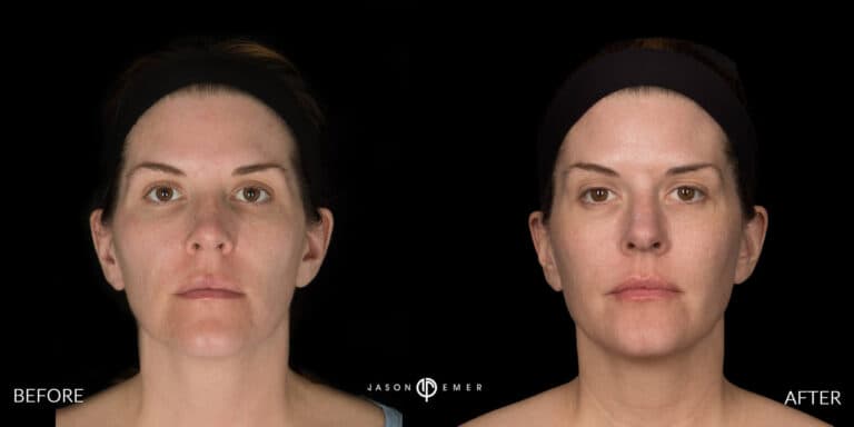 MICRONEEDLING GALLERY 01
