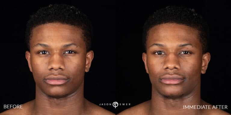 FACIAL SCULPTING MALE GALLERY 07