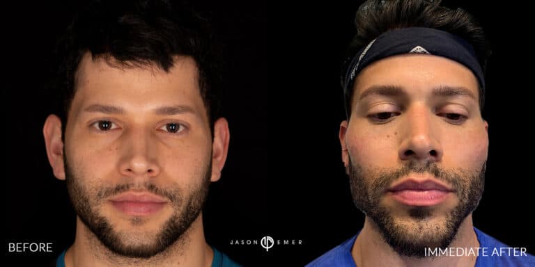 FACIAL SCULPTING MALE GALLERY 08