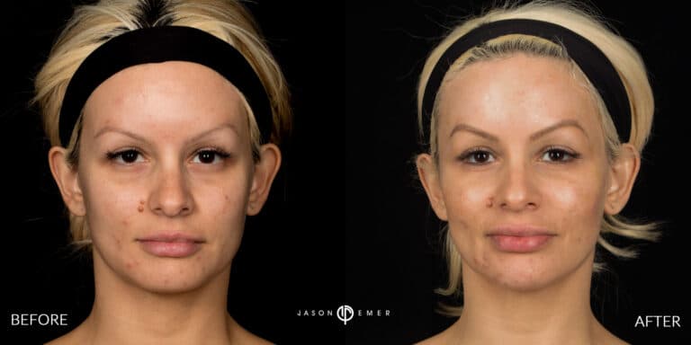 FACIAL SCULPTING FEMALE GALLERY 02