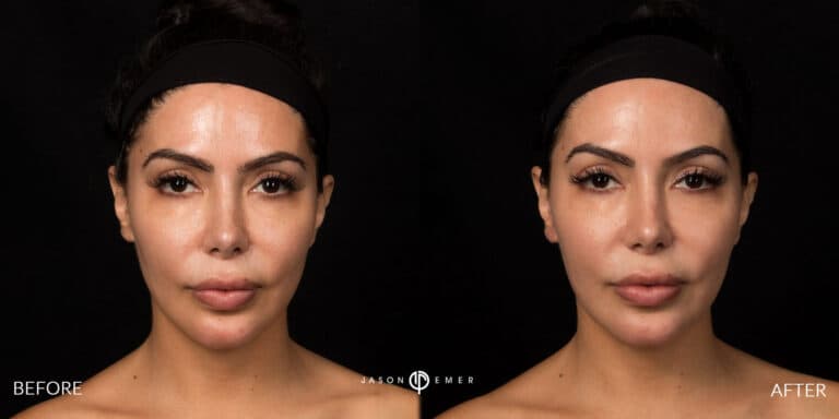 FACIAL SCULPTING FEMALE GALLERY 04