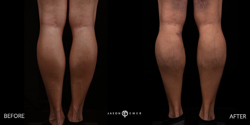 Calves Male Gallery