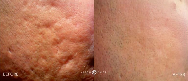 ACNE SCAR TREATMENT GALLERY 12