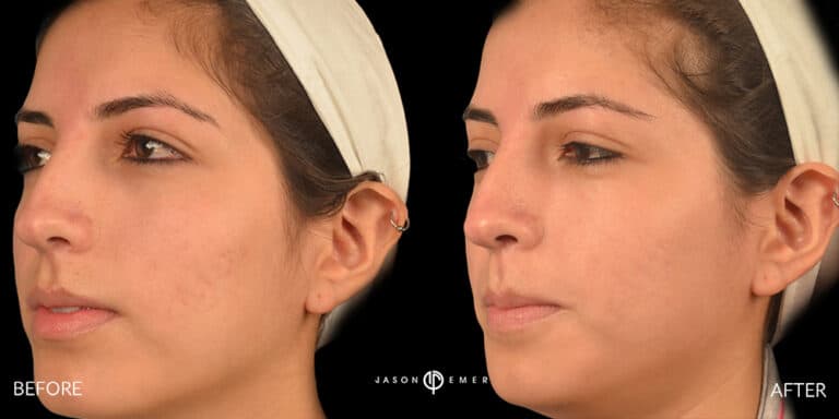 ACNE SCAR TREATMENT GALLERY 15