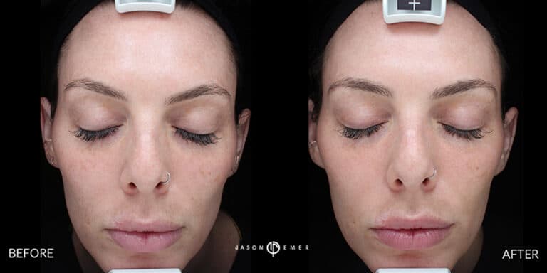 CHEMICAL PEELS GALLERY 02