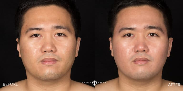CHEMICAL PEELS GALLERY 05