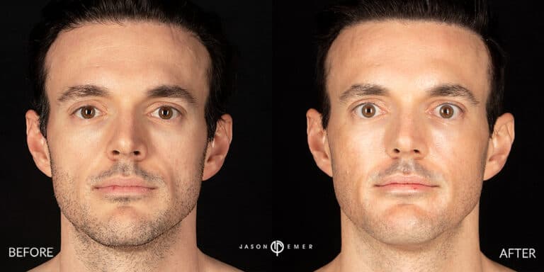 CHEMICAL PEELS GALLERY 06