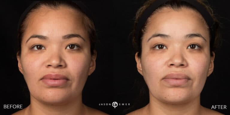 CHEMICAL PEELS GALLERY 07