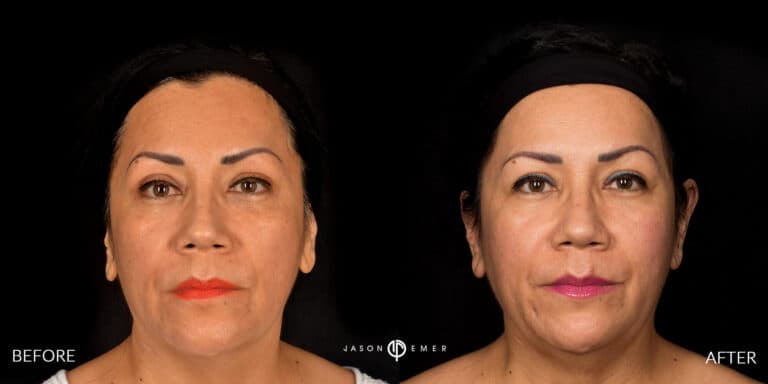 MICRONEEDLING GALLERY 02