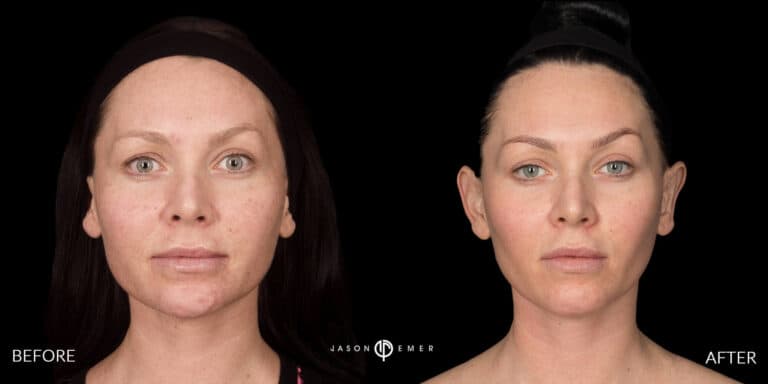 MICRONEEDLING GALLERY 03
