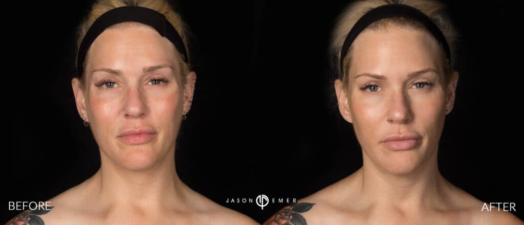 Dermaplaning Gallery