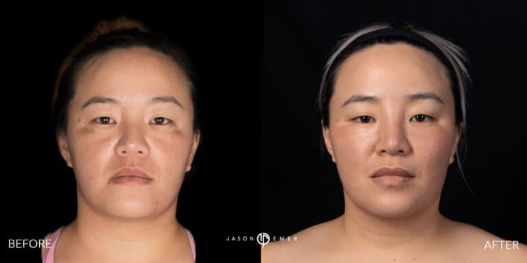 MICRONEEDLING GALLERY 04