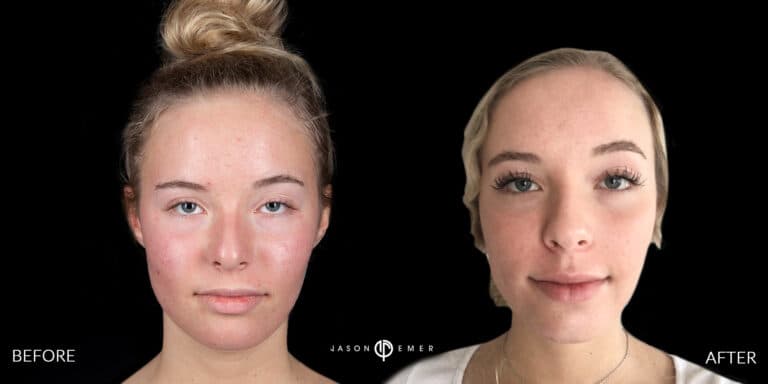 LASER SKIN RESURFACING GALLERY 03