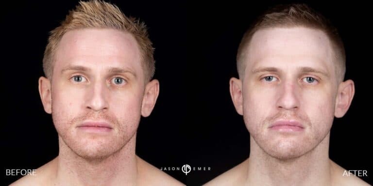 LASER SKIN RESURFACING GALLERY 04