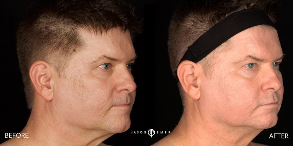 CO2 and Microneedling For Acne Scars Beverly Hills