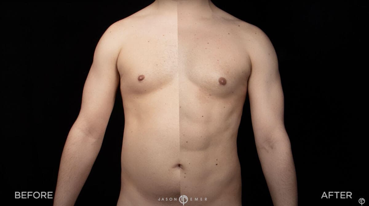 Body contouring result