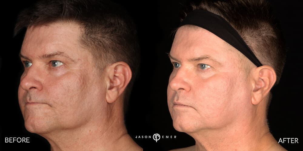 CO2 and Microneedling For Acne Scars Beverly Hills