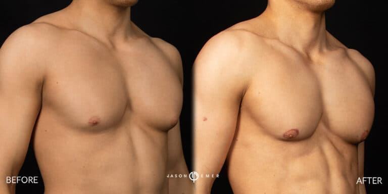 Chest Male Gallery 01