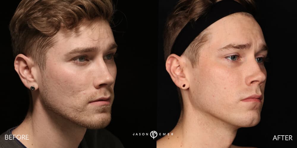 Acne scar best before and after los angeles beverly hills