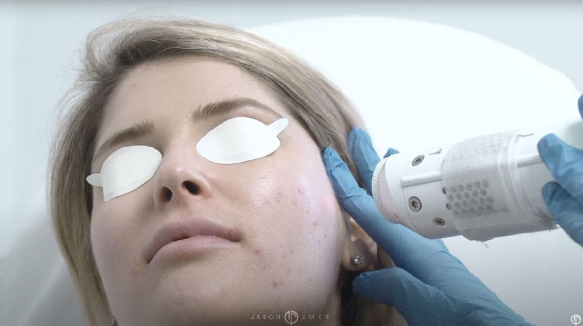 Laser dermatology treatment session for adult acne and skin rejuvenation by Dr. Jason Emer