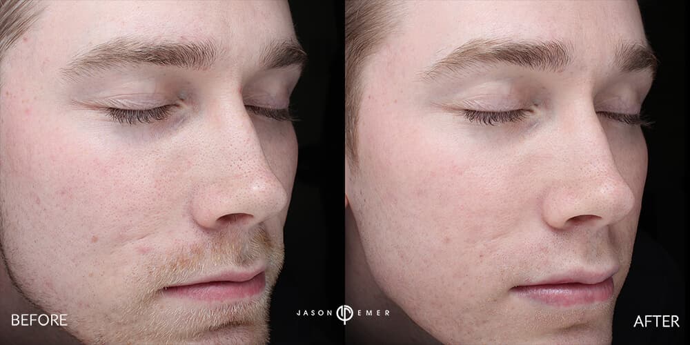 Acne scar best before and after los angeles beverly hills