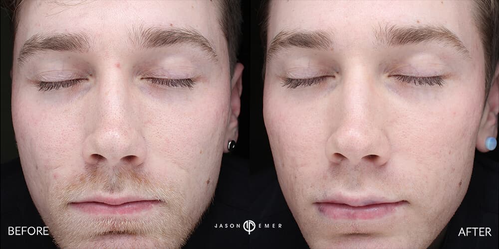 Acne scar best before and after los angeles beverly hills