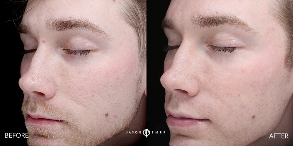 Acne scar best before and after los angeles beverly hills