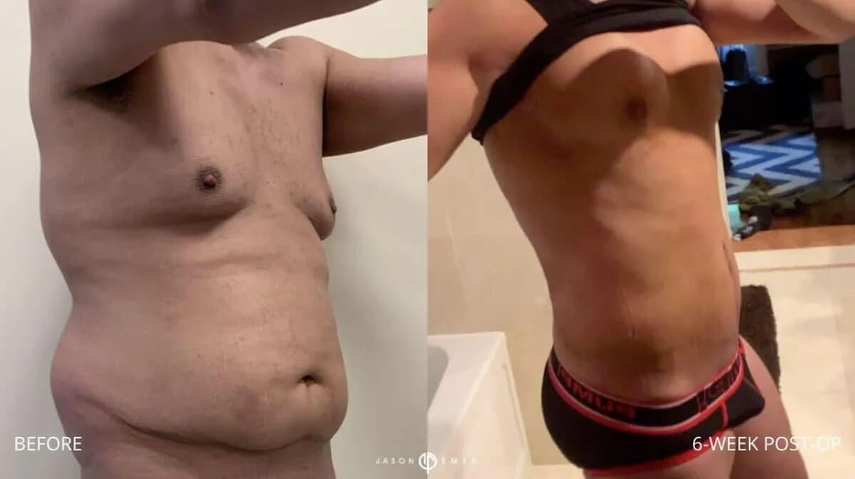 Editorial tummy tuck before-and-after contour study