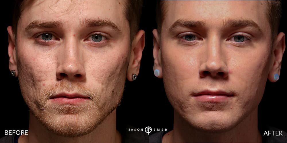 Acne scar best before and after los angeles beverly hills