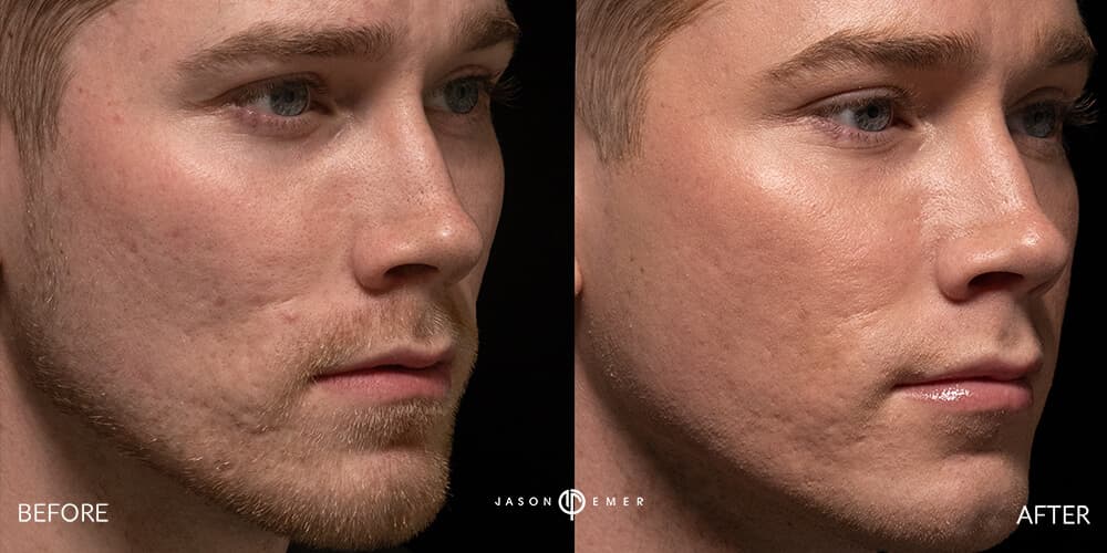 Acne scar best before and after los angeles beverly hills