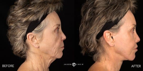 Facelift Procedures by Dr. Jason Emer at Emer Medical