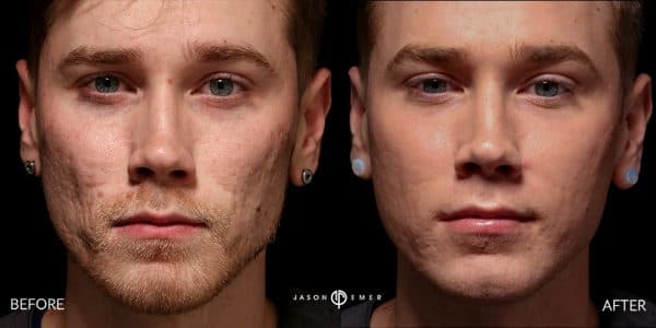 Chemical Peel | Before and After | Dr. Jason Emer MD | | Beverly Hills, CA