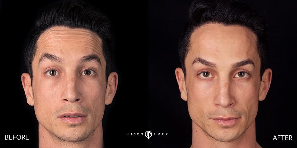 BOTOX