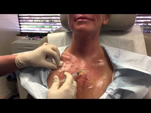 Patient story video 2