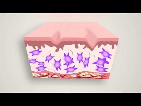 Patient story video 3