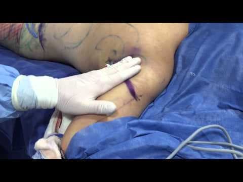 Patient story video 3