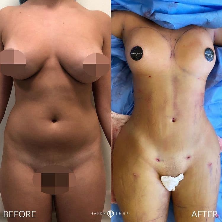 Dr. Jason Emer, board-certified dermatologist who performs Rib Remodeling