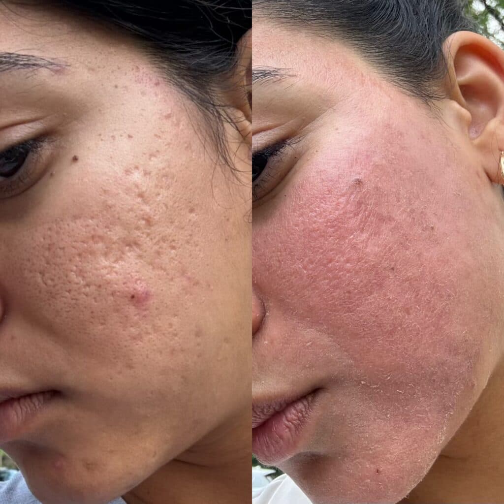 Silicone Injections