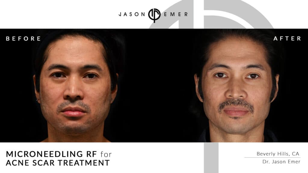 Microneedling for acne scar treatment | Before and After | Dr. Jason Emer MD | | Beverly Hills, CA